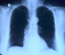 Заболеваемость туберкулезом в Казахстане за 6 лет снизилась в 1,6 раза