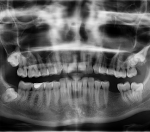 Потеря зубов может существенно увеличивать риск развития инфарктов и инсультов