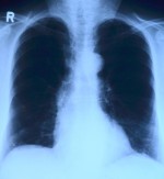 В Алматы эксперты обсудили вопросы борьбы с распространением туберкулеза в странах Центральной Азии